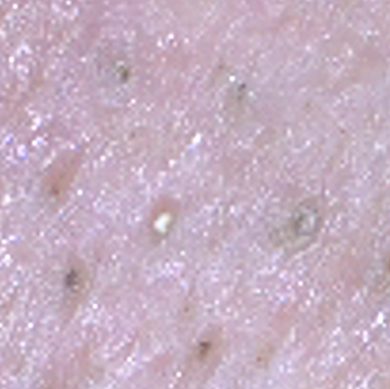 Magnified skin after irradiation